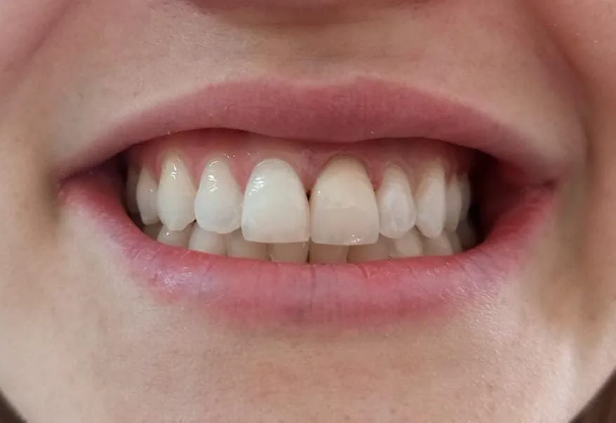 After teeth whitening